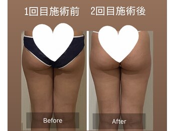 ウツク(utuku)/下半身BODYメイク　長岡/痩身
