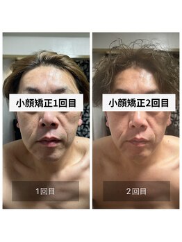 ダンニヒル(dannihil)/小顔矯正2回め