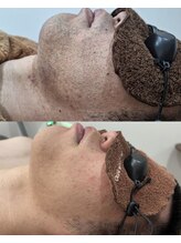 アカラ 読谷店(AKALA)/ヒゲ脱毛を継続して１年が経過