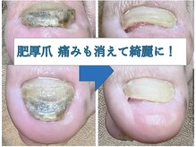 ひかわ整骨院 熊本巻き爪センター/肥厚爪のビフォーアフター