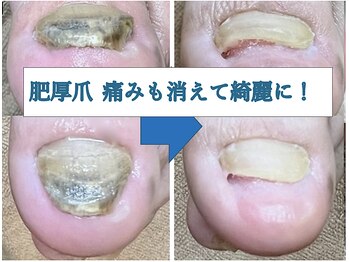 ひかわ整骨院 熊本巻き爪センター/肥厚爪のビフォーアフター