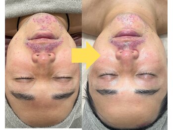 フェイスプラスリフ(FACE+RiF)/ニキビ、肌荒れ