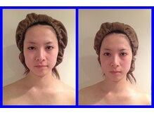 ブルームーン コルギアンドエステティック(Blue moon)/お顔のコルギのbefore after