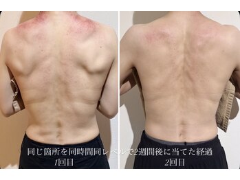 スリミア(Slimia)/温活筋膜リリース