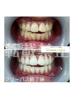 ホワイトニングサロン 札幌店/【ホワイトニング】#札幌#大通り