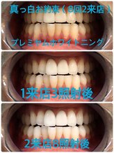 ホワイトニングビューティー 吉祥寺店/症例写真_2回来店されたお客様