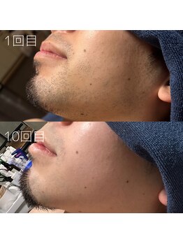 カナウ(KANAU)/ヒゲ脱毛（20代前半男性）