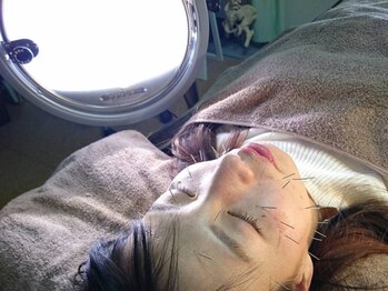 マッチ鍼灸整骨院/美容鍼×肌改善光線でニキビケア