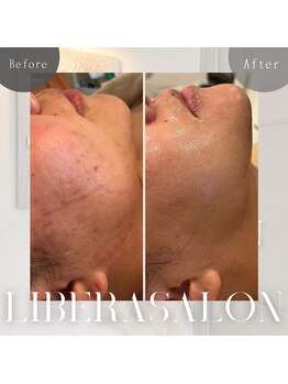 リベラサロン(LIBERA SALON)/ニキビ改善&リフトUP!
