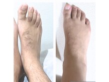 グリシーヌ(GLYCINE)/脱毛の効果★