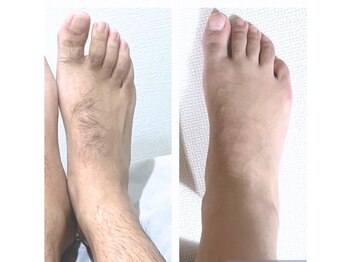 グリシーヌ(GLYCINE)/脱毛の効果★