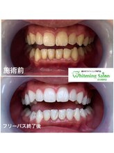 ホワイトニングサロン 名古屋駅店/【ホワイトニング施術例】