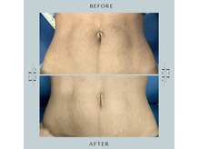 ジルフィー(GILFY)/再生美容技術☆エクソリフト