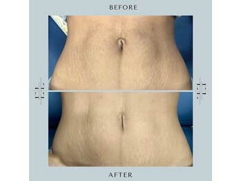 ジルフィー(GILFY)/再生美容技術☆エクソリフト