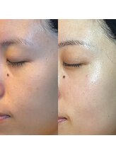 エラ(ella)/20代　肝ぱん・シミ・肌質改善