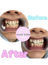 エクシアホワイトニング エミフルMASAKI店/ビフォーアフター