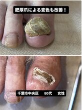 巻き爪じゅん 千葉駅前店/千葉市中央区の肥厚爪改善！