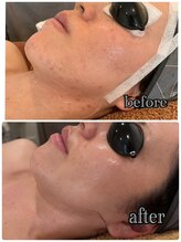 エイチビー(HB)/IPL光フェイシャル効果