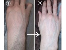 ベル(Belle+vi)/腕脱毛♪