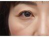 《目の下のたるみ・青・黒クマ集中改善》リフトアップ美容鍼＋LED