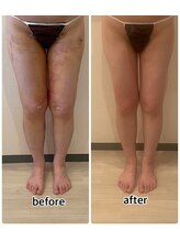 インディバジェム(GEM)/ビフォーアフター