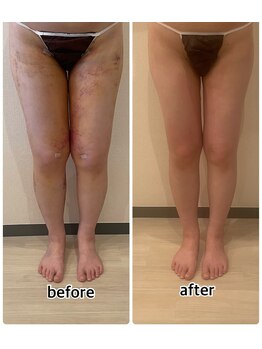 インディバジェム(GEM)/ビフォーアフター