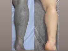 メグサロン(megu salon)/宇土市/メンズ脱毛/肌ツルツル！