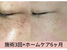 マインドール/施術3回目シミ、シワ軽減