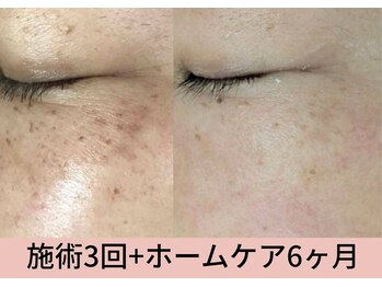 マインドール/施術3回目シミ、シワ軽減