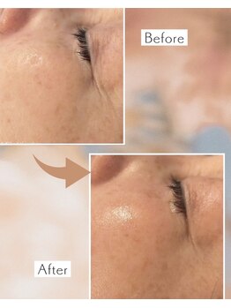 ピーチ ローズ(peach rose)/お肌の張りアップ