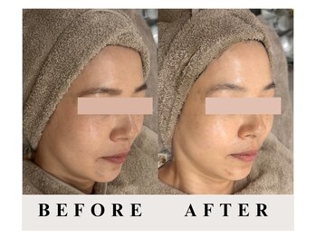 バーガルサロンギンザ(VAGAL SALON GINZA)の写真/【エイジングケア】ハリツヤUPしたい方、ほうれい線やしわ・たるみケアがしたい方に♪[銀座駅徒歩30秒]