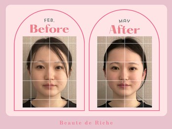 ボーテドリッシュ(Beaute de Riche)/小顔矯正beforeafter