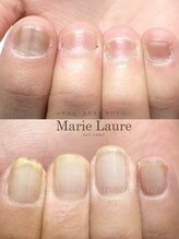 マリーロール 淀屋橋本店(Marie Laure)/自爪育成/深爪矯正/ネイルケア