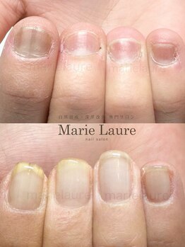 マリーロール 淀屋橋本店(Marie Laure)/自爪育成/深爪矯正/ネイルケア