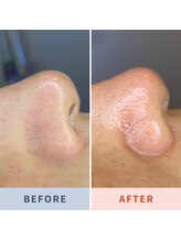 ソリス ビューティー(SOLIS BEAUTY)/毛穴洗浄