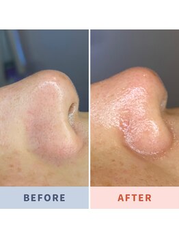 ソリス ビューティー(SOLIS BEAUTY)/毛穴洗浄