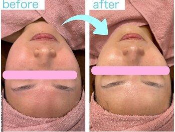 クローバー(clover)/人気Ｎｏ1毛穴洗浄＋ララピール