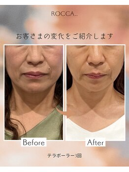 ロッカ(ROCCA..)/テラボーラー