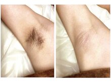 ルミエール(Lumiere)の雰囲気(-5℃で冷却しながら照射!痛みは最小限に抑えながら効果は抜群!)