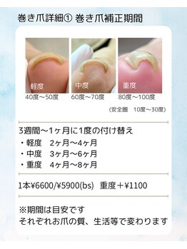巻き爪フットケアサロン 神楽坂/巻き爪詳細1