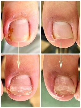 名古屋駅前巻き爪センター/陥入爪