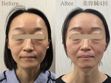 ライフサロン 天神(Life Salon)/美容鍼Before /After◎