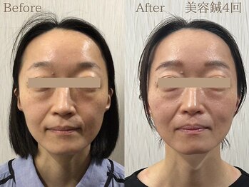 ライフサロン 天神(Life Salon)/美容鍼Before /After◎