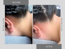 テリー(Terry)/襟足ワックス脱毛　before after