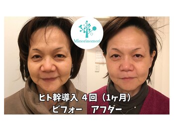 ミノリノモリ(Minorinomori)の写真/【最先端美容マシン】ヒト幹細胞培養フェイシャルでお肌悩みを徹底改善!年齢を感じさせないつるん美肌に◇