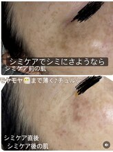 アルページュ(Arpege)/水滴LDM×スポットシミケア♪