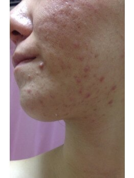 スキンケアスタジオ アコ 新宿店(Aco)/GP5Dほほポツポツ肌のお客様