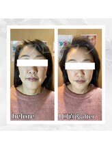 フローフシ∞/【小顔】40代女性症例写真