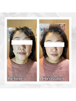 フローフシ∞/【小顔】40代女性症例写真