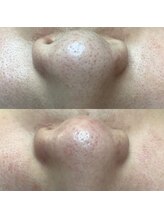 カンパニュラ(campanula)/#毛穴エクストラクション